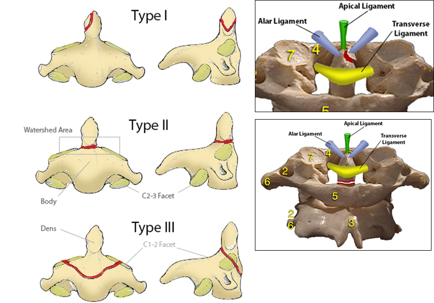 Odontoid Fracture Spine Orthobullets Odontoid Fracture Spine Orthobullets